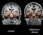 All you need to know about brain scans and dementia ... All you need to know about brain scans and dementia ...